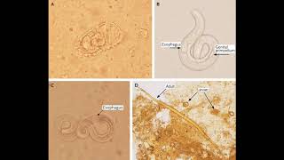 Strongyloides stercoralis  morphology life cycle pathogenesis diagnosis and treatment [upl. by Holly]