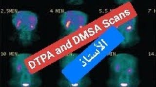 DTPA and DMSA scans [upl. by Enaek]