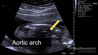 Understanding your fetal ultrasound [upl. by Ayaj]