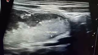 Échographie abdominale estomac [upl. by Repooc]