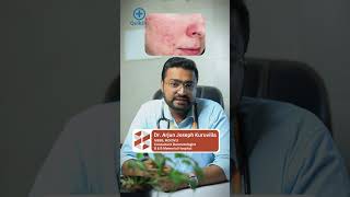 മുഖക്കുരു പാടുകൾ എങ്ങനെ എളുപ്പത്തിൽ മാറ്റാം  Acne Scars Treatment Malayalam [upl. by Lyndsey]