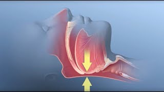 Obstructive Sleep Apnea  Mayo Clinic [upl. by Wolf]