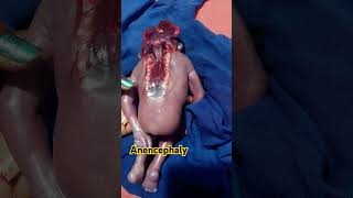 5 month baby with anencephaly  neural tube defect [upl. by Suaeddaht]