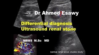 ULTRASOUND RENAL STONE DIFFERENTIAL DIAGNOSIS [upl. by Rediah]