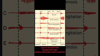 aortic regurgitation murmur apex beat mcqs important points [upl. by Adaha]