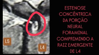 02102024  TF L4L5  HERNIA FORAMINAL CALCIFICADA  COMPRESSÃO RAIZ EMERGENTE DE L4 [upl. by Anurb]