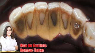 Worst Tartar I have seen Watch how we remove it Both front and back teeth are full of tartar [upl. by Anali]