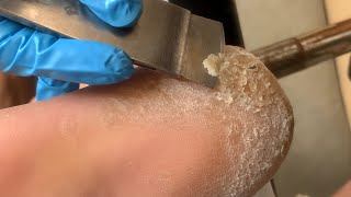 Callus removal from feetampFoot scraping dead skin【Xiao Yan pedicure】stress 1112 [upl. by Zora28]