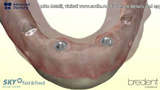 Immediate loading procedure for bredent implants  Fixed Teeth in 24 Hours [upl. by Aimerej]