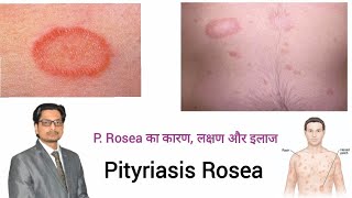 Pityriasis Rosea  P Rosea का कारण लक्षण और इलाज pityriasis rosea treatment in hindi prosea [upl. by Adela]