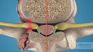 What is Cervical Lateral Stenosis AtlanticSpineCenter [upl. by Eissirc]