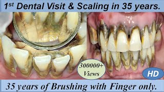 Massive Firm amp Hard Black Calculus Removal by Ultrasonic Scaling I 1st Dental Cleaning in 35 years [upl. by Annayek450]