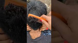 Dandruff and louse removal home remedy [upl. by Senoj775]