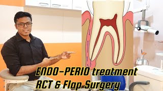 Periodontal flap surgery and Endodontic treatment root canal of ENDOPERIO lesion [upl. by Ferneau552]