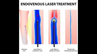 Operația de varice cu laser și recidiva  Varicele reapar dupa operatie Stefan Jianu  ProEstetica [upl. by Ahsemat664]