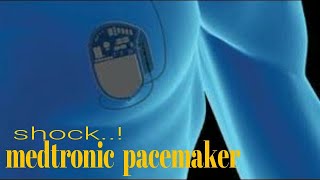 medtronic pacemakers [upl. by Eirual]