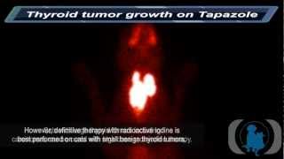 Thyroid Tumor Growth on Tapazole [upl. by Matronna]