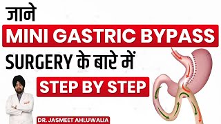 Mini Gastric Bypass  In Hindi  Adjustable Gastric Banding Sleeve Gastrectomy Weight Loss Surgery [upl. by Sternlight345]