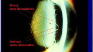 Slit lamp examination 36 [upl. by Kolk]