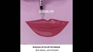 Russian Lip Filler Technique  Russian Lips Style Filler in Dubai russianlip lipfiller [upl. by Vachil]