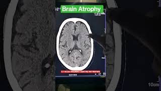 NCCT HEAD CT SCAN HEAD ANATOMY PATHOLOGY FILMING [upl. by Naes]