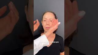 PACIENTE 67 ANOS COM ELASTOSE rejuvenescimentofacial hof [upl. by Nura236]