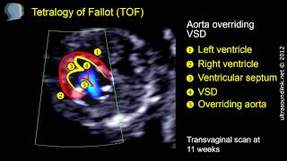 Tetralogy of Fallot TOF echo at 11 weeks [upl. by Moreland]