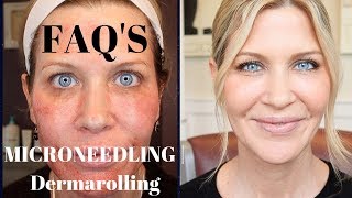 Microneedling  Dermarolling QampA  Before During and After Pics [upl. by Ttehc]