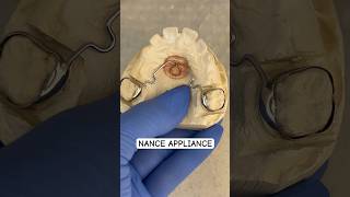 NANCE ORTHODONTIC appliance [upl. by Aderfla]