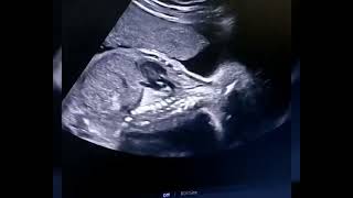 Sacrococcygeal teratoma in pregnancy ultrasound [upl. by Sillert866]