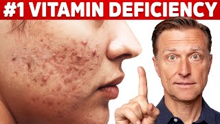 The Top Vitamin Deficiency with Acne [upl. by Nallac]