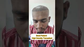 Beed Patient  High density hair transplant [upl. by Capwell]