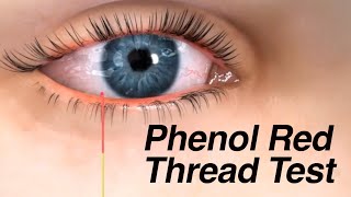 Phenol Red Thread Test for Dry Eyes [upl. by Zipah]