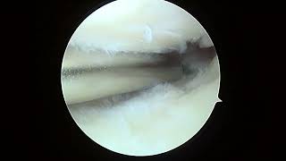 L knee debridement 11 14 24 ST [upl. by Richardson]