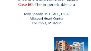 Case 60 Manual of CTO Interventions  Impenetrable proximal cap [upl. by Enirok]