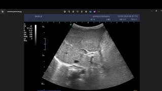 Portal vein chronic thrombosis with cavernous transformation [upl. by Ahsiatal]