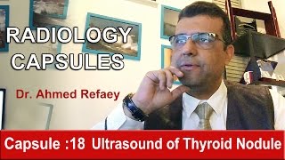 Capsule  18  Ultrasound of Thyroid Nodule [upl. by Eseryt]