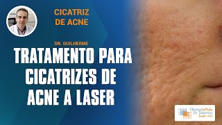 Cicatrizes de Acne Laser de CO2 Fracionado DEKA [upl. by Agbogla]