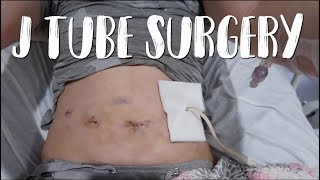 Straight J Tube Jejunostomy Surgery  Feeding Tube For Gastroparesis [upl. by Andrien]