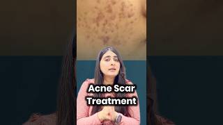 acne scar treatment  how to get rid of acne scars  silicon creams  retinoids  silicon for scars [upl. by Elletsyrk573]