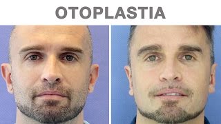 Otoplastia antes y después  Testimonio de David [upl. by Andaira]