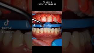 TREATMENT FOR GUM BLEEDING DENTAL CLEANING [upl. by Aileda]