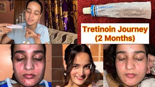 2 Month RetinolTretinoin Journey✨ [upl. by Aiza]