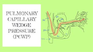 Pulmonary capillary wedge pressure PCWP [upl. by Alodee]