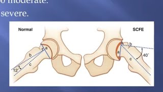 Slipped Capital femoral epiphysis for the FRCS Orth [upl. by Fayola759]