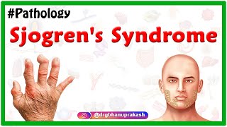 Sjogrens syndrome Usmle  Etiology  Clinical features  Diagnosis  Treatment [upl. by Millian]