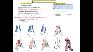 Coronary bifurcation stenting modern algorithms and details of provisional techniques Elias Hanna [upl. by Lissi]