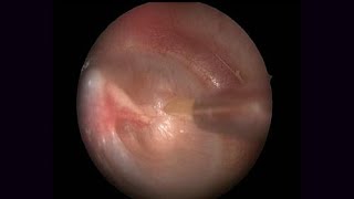 Myringotomy and Suction Clearance of Middle Ear Fluid [upl. by Elehcor]