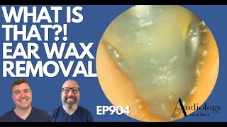 WHAT IS THAT EAR WAX REMOVAL  EP904 [upl. by Ihpen]