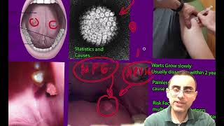 Oral Warts Explained Causes Symptoms and Treatments [upl. by Udenihc]